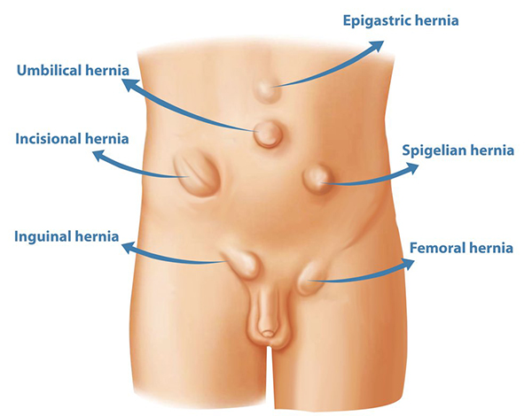 Abdominal & Groin Hernia Img
