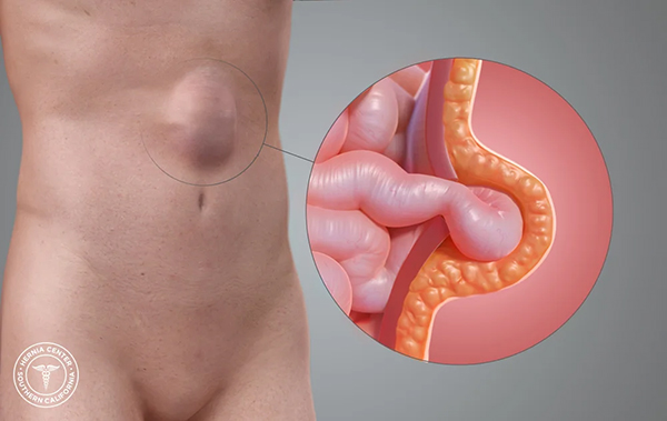 Abdominal Hernia Img