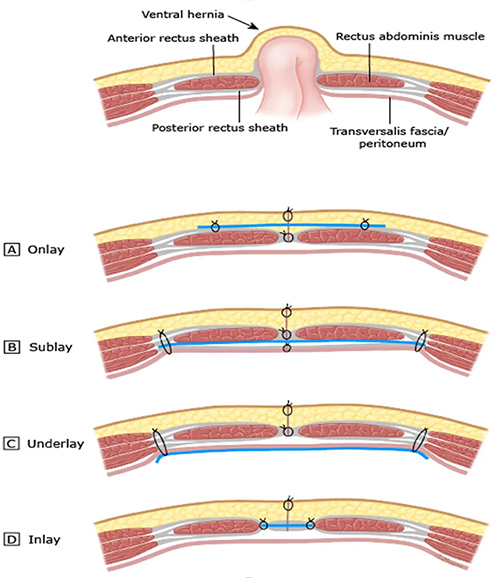 Abdominal Hernia Img