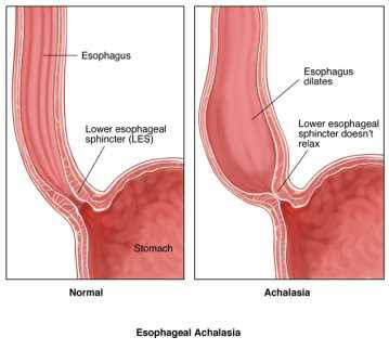 Achalasia - Educational Photo