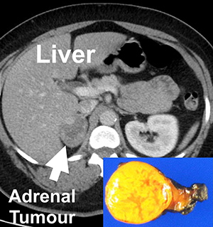 Adrenal CT Scan Img