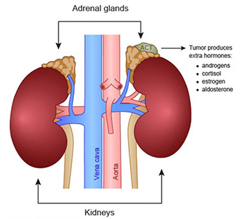 Adrenal Gland Tumours Img