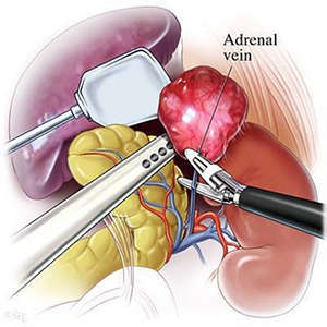 Adrenal CT Scan Img