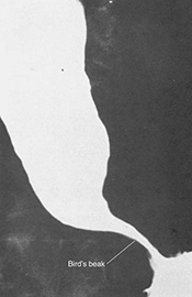 Barium Swallow Achalasia - Educational Photo
