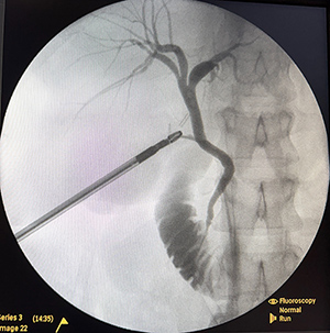 Cholecystectomy Image