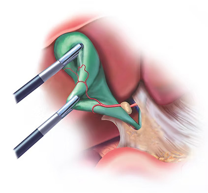 Cholecystectomy Image