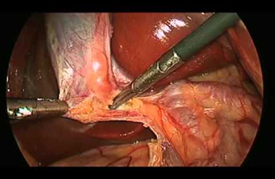 Cholecystectomy Image