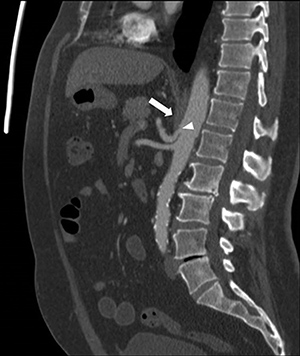 CT Angiography Median Arcuate Ligament Syndrome Img