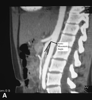 CT Angiography Superior Mesenteric Artery Syndrome Img
