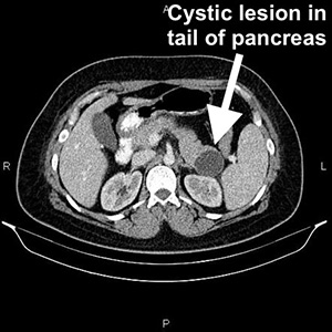 CT Pancreas