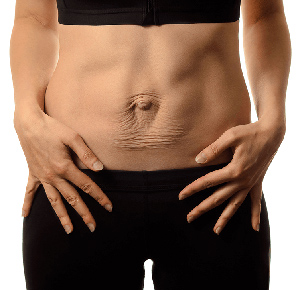 Diastasis Recti Img