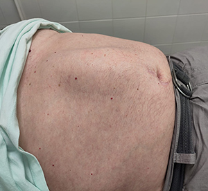 Diastasis Recti Img