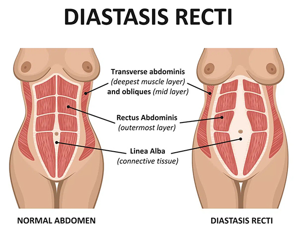 Diastasis Recti Img