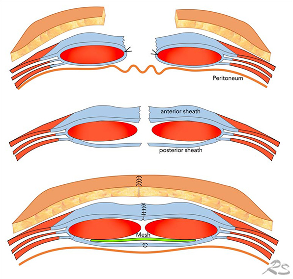 Diastasis Recti Img