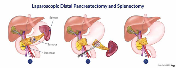 Distal Pancreatectomy