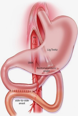 Duodenojejunostomy Superior Mesenteric Artery Syndrome Img