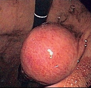 Gastrointestinal Stromal Tumour (GIST) Endoscopy Img