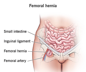 Femoral Hernias Img