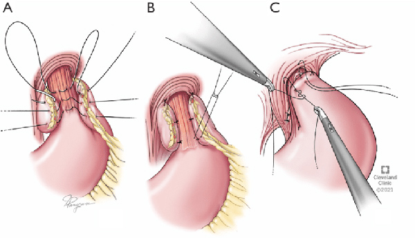 Fundoplication Surgery Img
