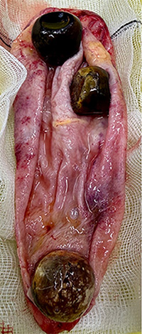 Gallbladder Image