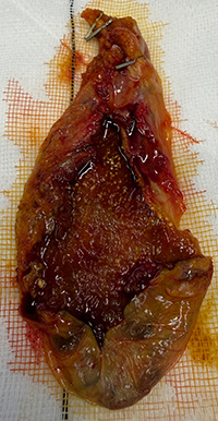 Gallbladder Image
