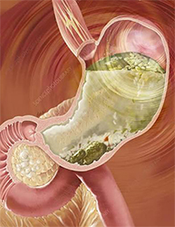 What is gastroparesis?