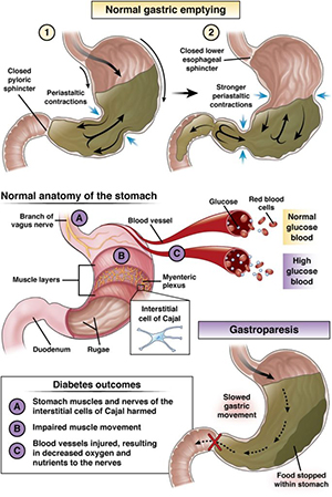 What causes gastroparesis?