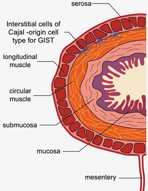 Gastrointestinal Stromal Tumour (GIST) Cells of Cajal Img