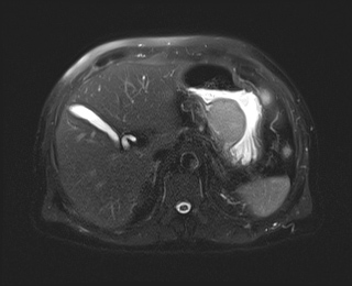 Gastrointestinal Stromal Tumour (GIST) CT scan Img