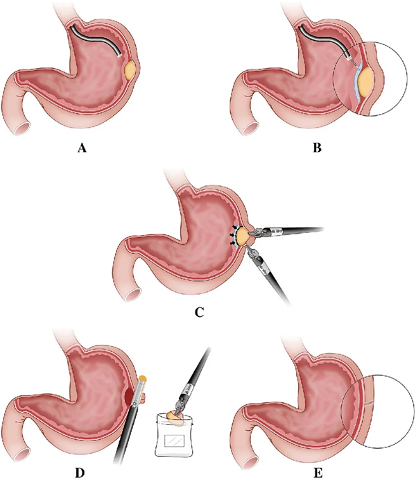 Gastrointestinal Stromal Tumour (GIST) Surgery removal Img