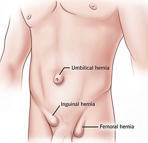 Groin Hernias Img