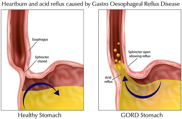 Heartburn Reflux Img