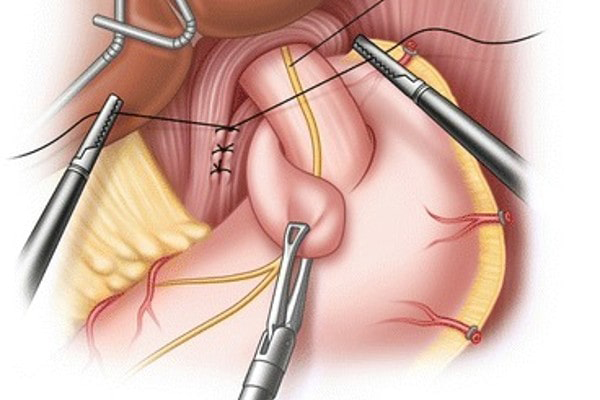 Heartburn Reflux Img