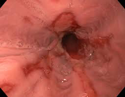 Heartburn Reflux Img