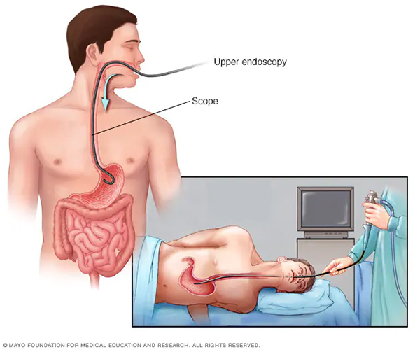 Heartburn Reflux Img