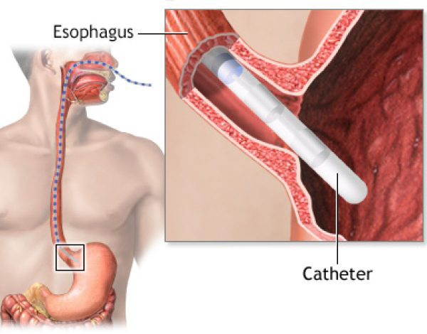 Heartburn Reflux Img