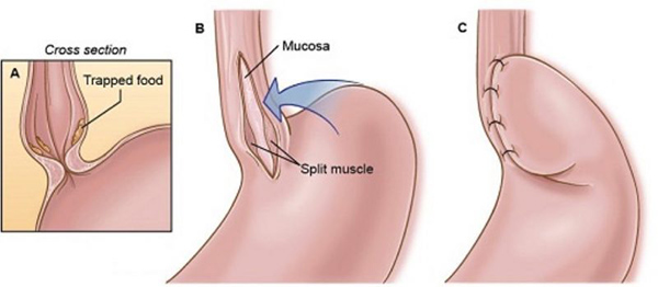 Laparoscopic Heller's Myotomy Achalasia - Educational Photo