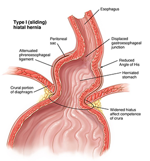 Hiatus Hernia Repair Img
