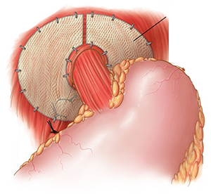 Hiatus Hernia Repair Img