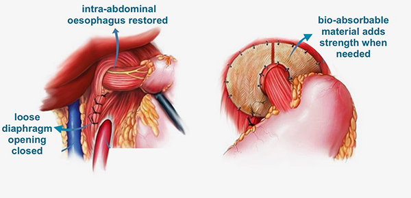 Hiatus Hernia Repair Img