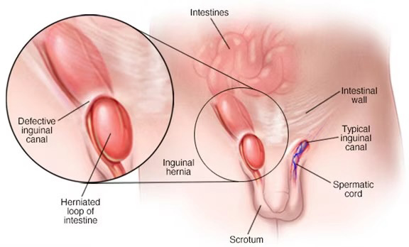 Inguinal Hernia Img