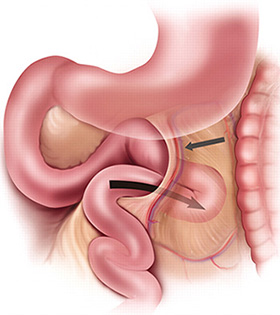 Internal Hernia