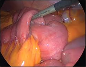 Intussusception