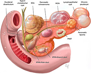 Intraductal Papillary Mucinous Neoplasms