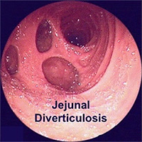 Jejunal Diverticulosis
