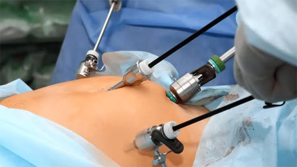 Laparoscopic Surgery Image