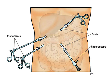 Laparoscopy