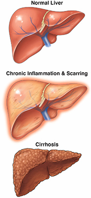 Liver Img