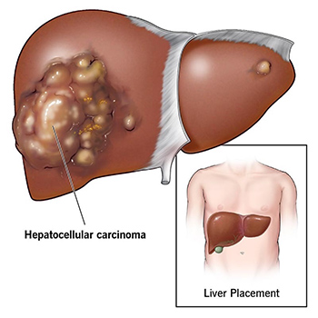 Liver Img