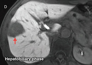 Liver MRI Img